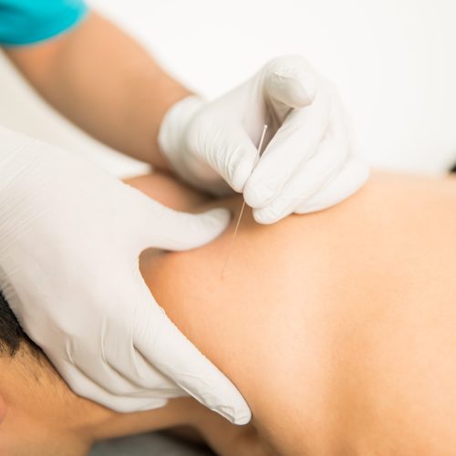Dry needling Mysio Fysiotherapie